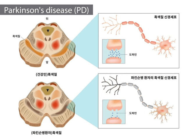 몰라서 두려운'파킨슨병'... 초기 적극적인 치료 필수